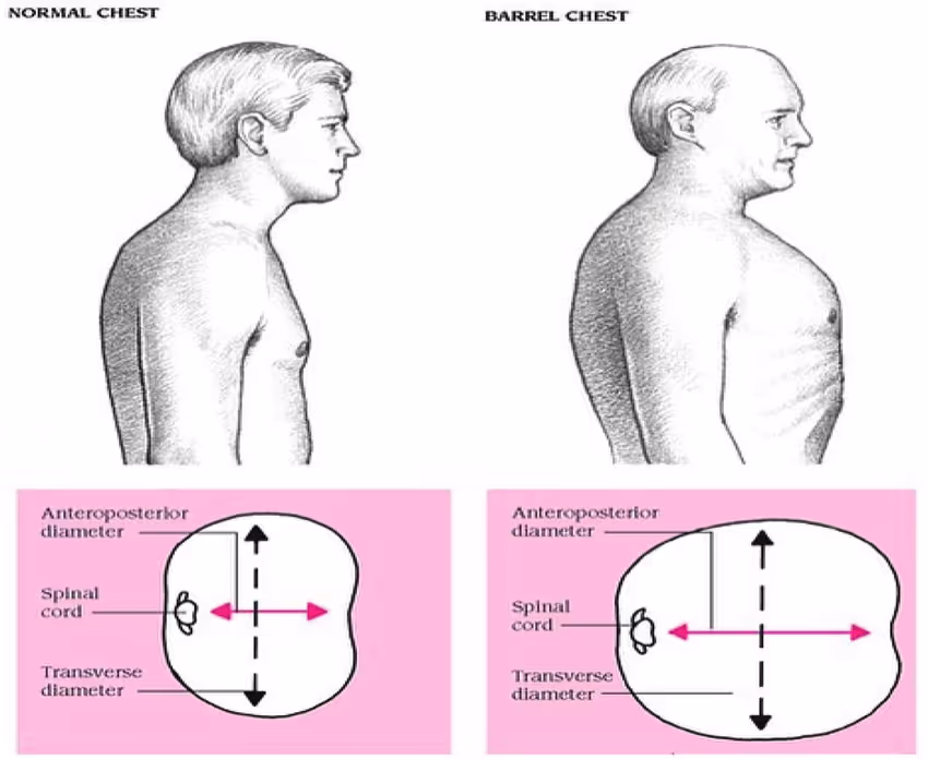 Tórax em barril, alteração típica da DPOC.
