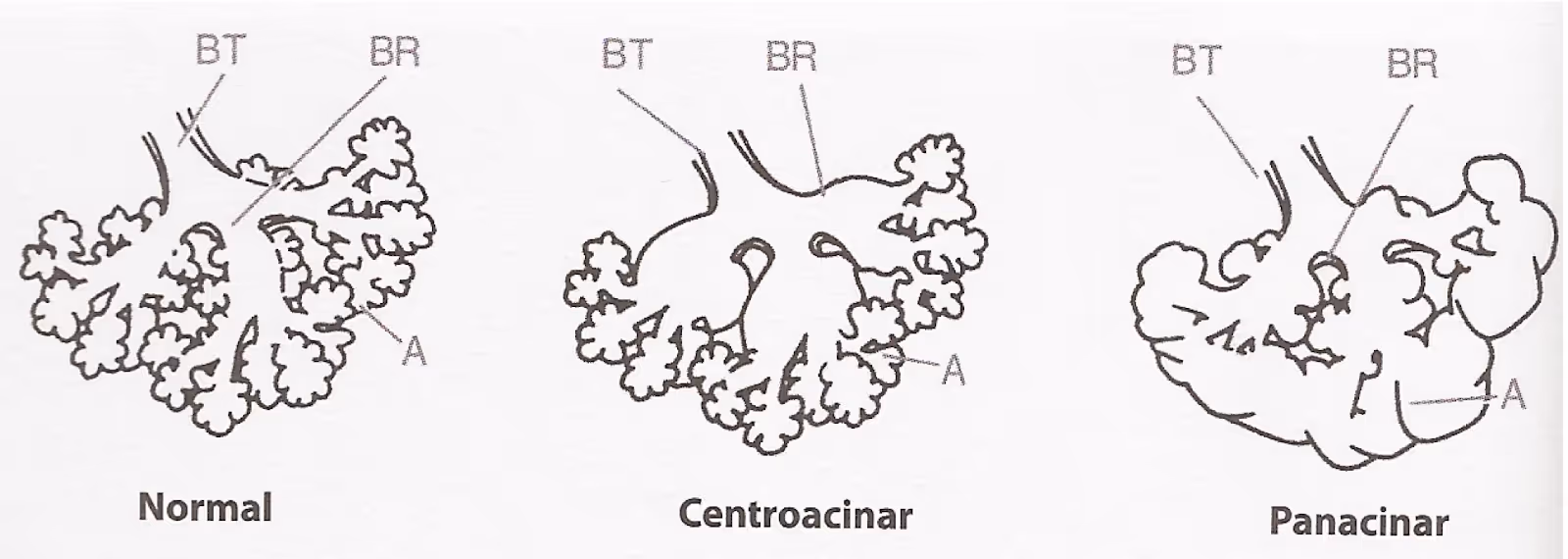 Tipos de enfisema pela localização do processo destrutivo