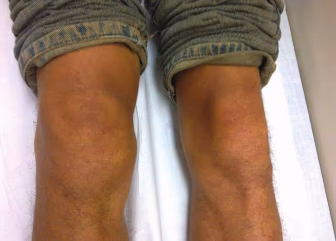 Imagem mostrando uma monoartrite de joelho com sinais inflamatórios