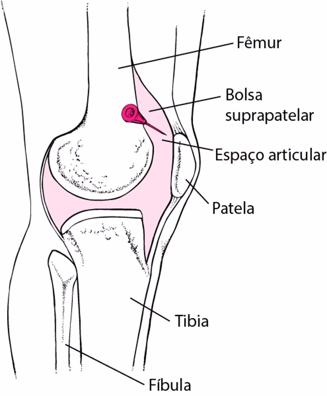 Esquematização de uma artrocentese do joelho
