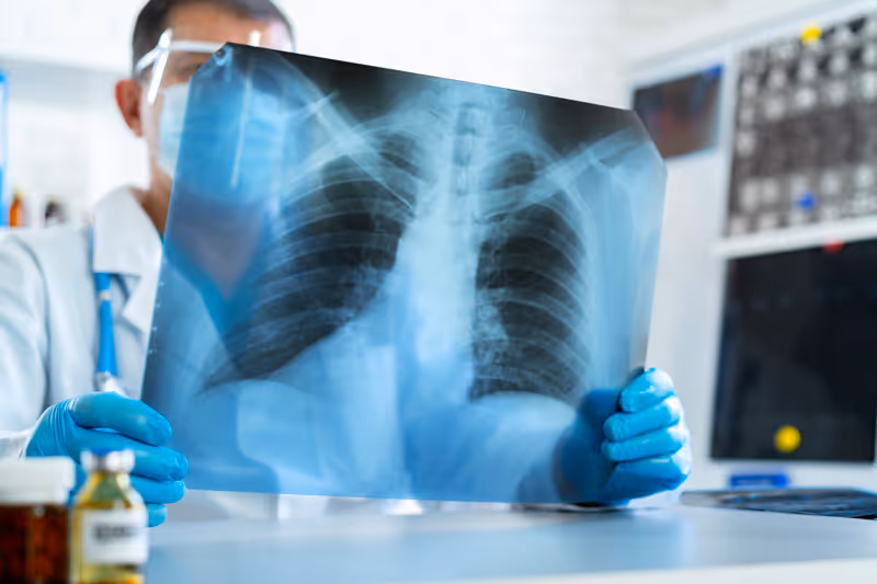 A avaliação do comprometimento do pulmão deve ser feita com raio-x do tórax