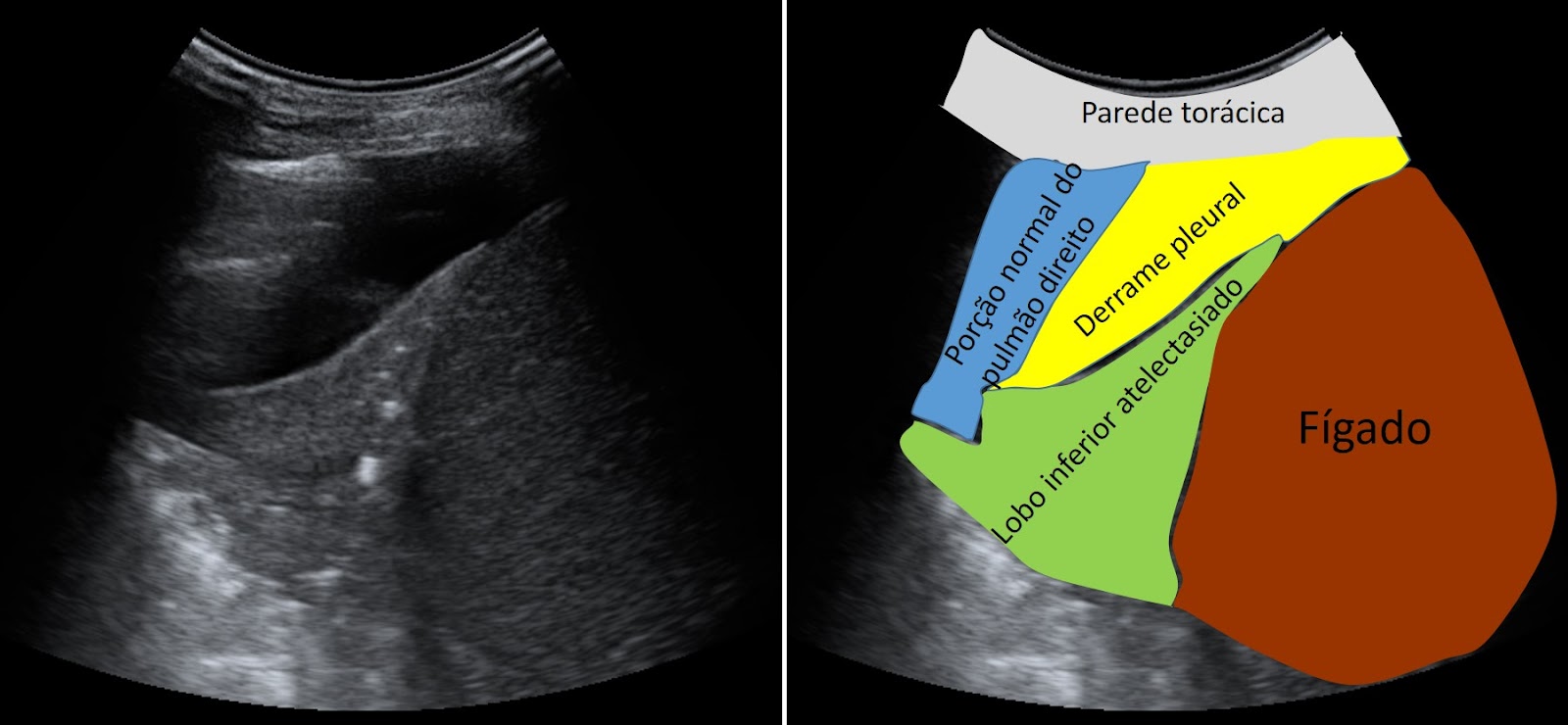 Derrame pleural evidenciado em USG