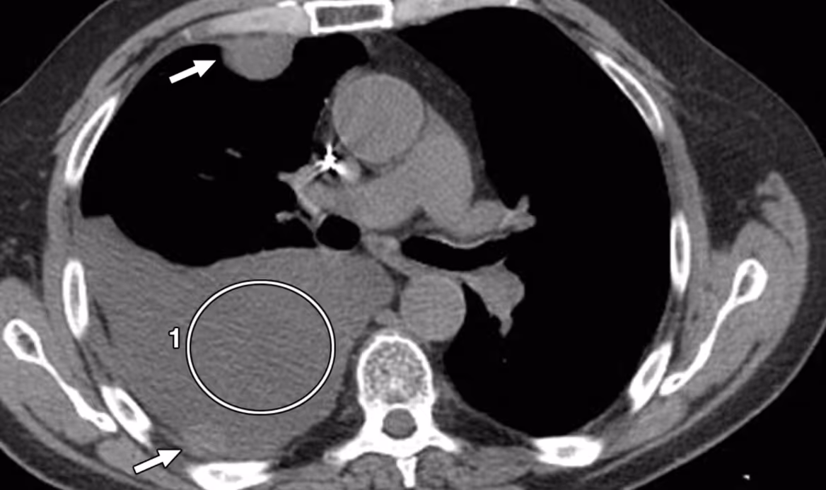 Tomografia computadorizada de tórax sem contraste em paciente de 79 anos, evidenciando derrame pleural direito. O paciente em questão apresentava exsudato pleural secundário a carcinoma de cólon com metástase pleural (setas brancas)