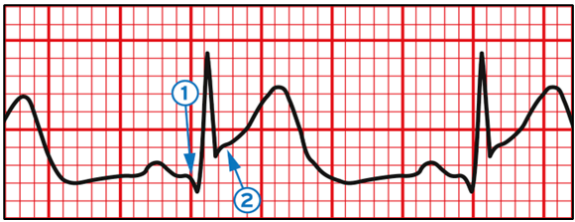 Supradesnivelamento de ST (2mm) entre a linha de base (seta 1) e o ponto J (final do complexo QRS e início do segmento ST, evidenciada pela seta 2)