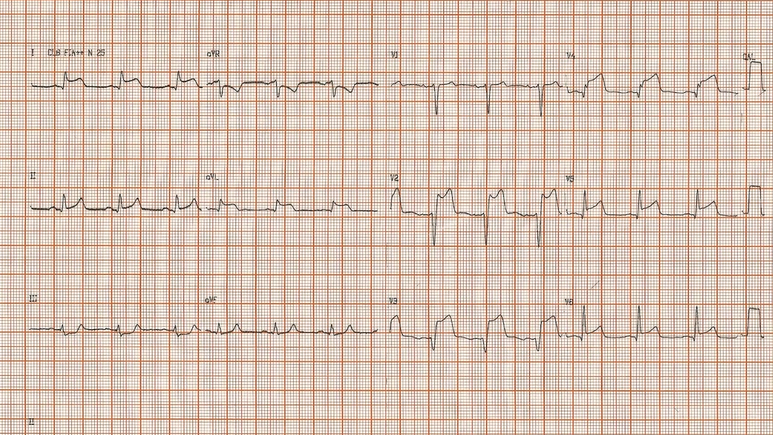 IAM com supra em que há acometimento de toda parede anterior, além de acometimento em DI e aVL. Nesse caso, o infarto é chamado de infarto anterior extenso. Fonte: Life in the Fast Lane (LITFL)