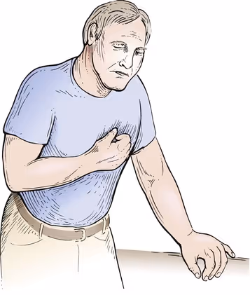 Ilustração representativa do Sinal de Levine, gesto em que pacientes com dor torácica, especialmente a angina ou dor relacionada a infarto, geralmente realizam