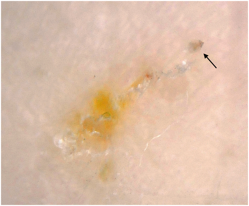 Imagem mostrando o sinal da Asa delta na Dermatoscopia