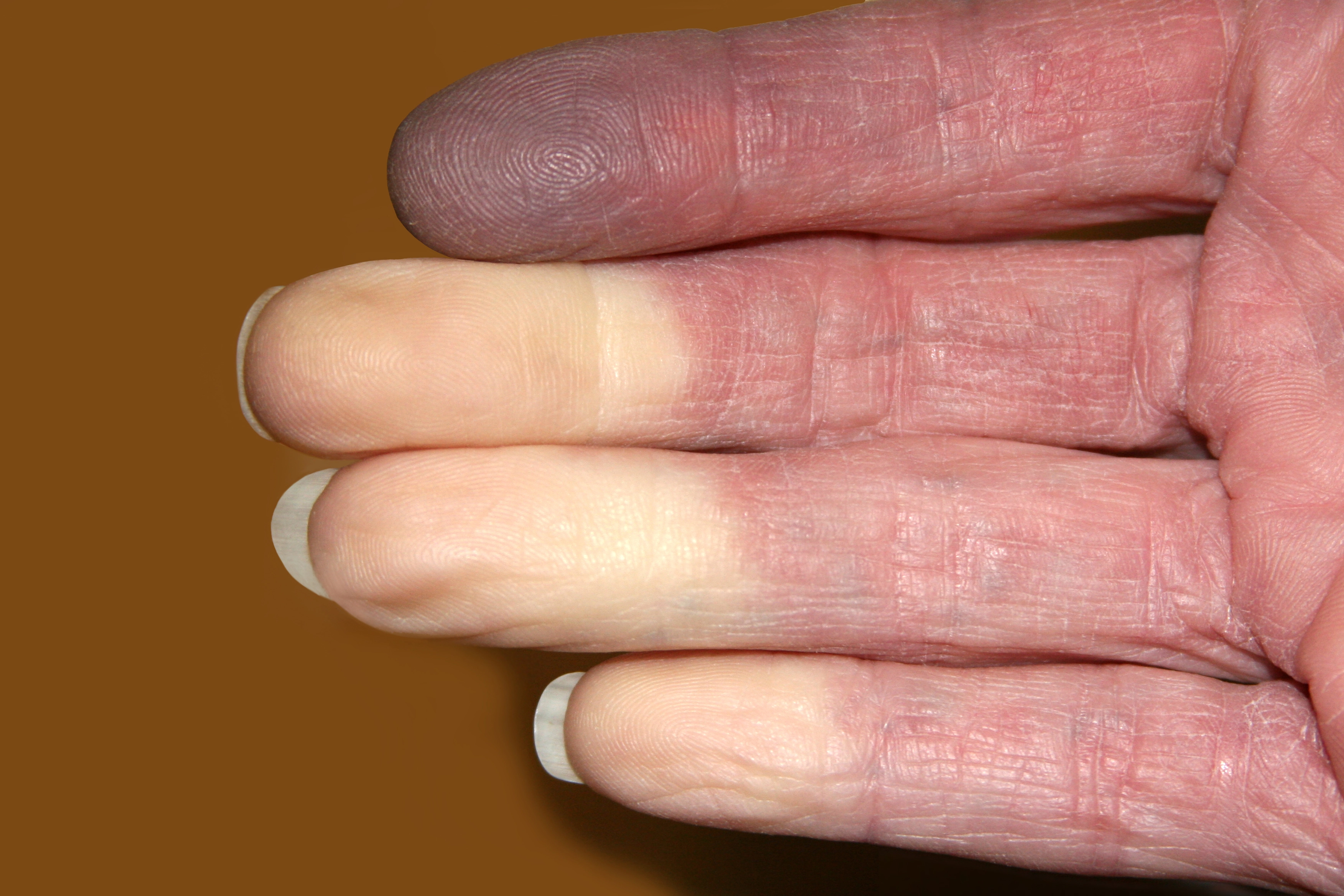 Fenômeno de Raynaud. Fonte-Shutterstock