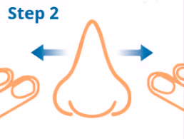 Cottle Maneuver Step 2