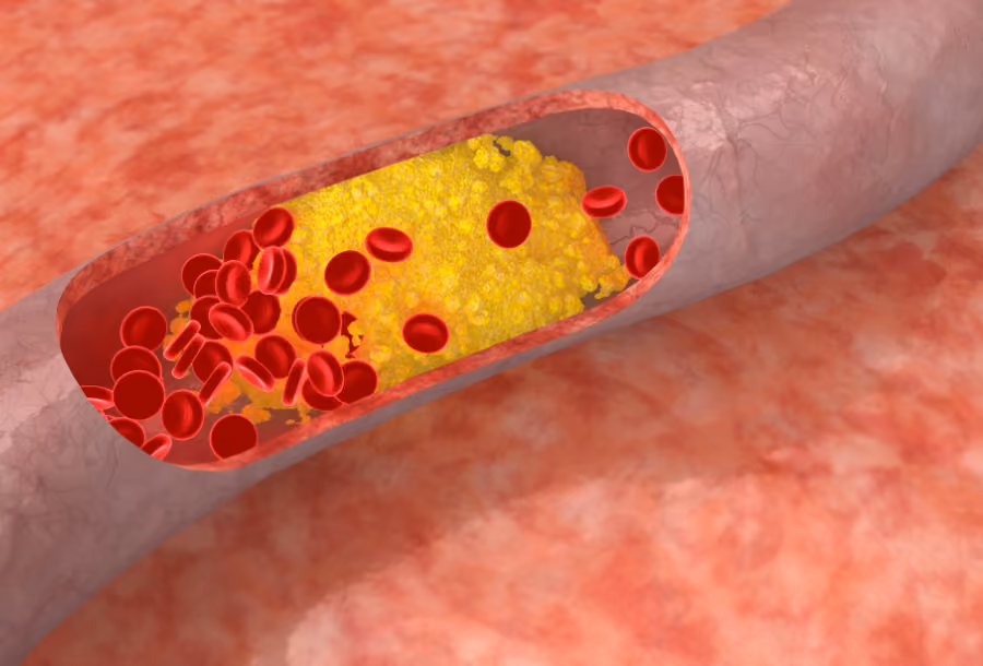 Beyond LDL cholesterol: why ApoB and lipoprotein(a) could save your life