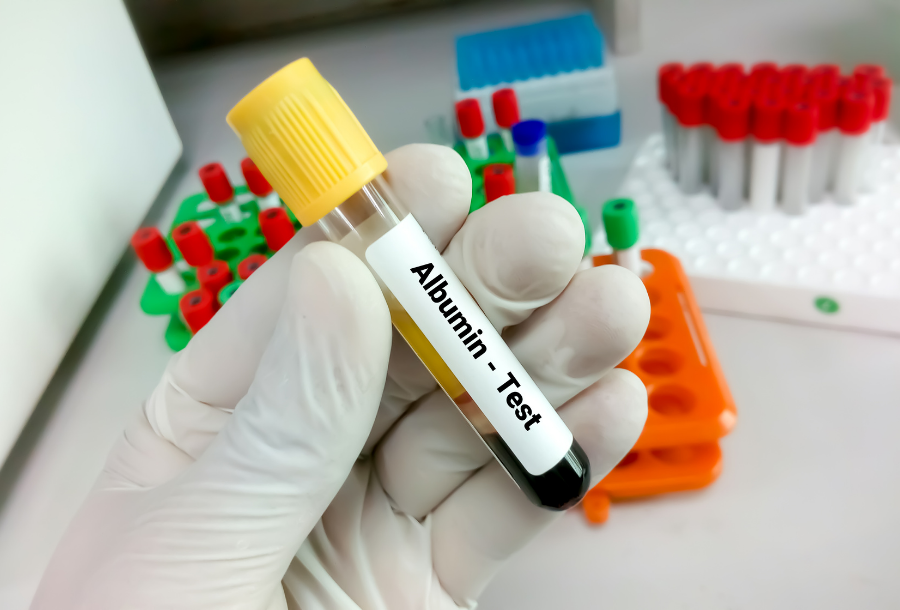 Albumin Blood Test Australia: Guide and Results
