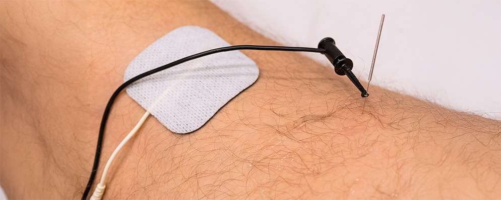 Aplicación de electrólisis percutánea con aguja y electrodo en tratamiento de fisioterapia
