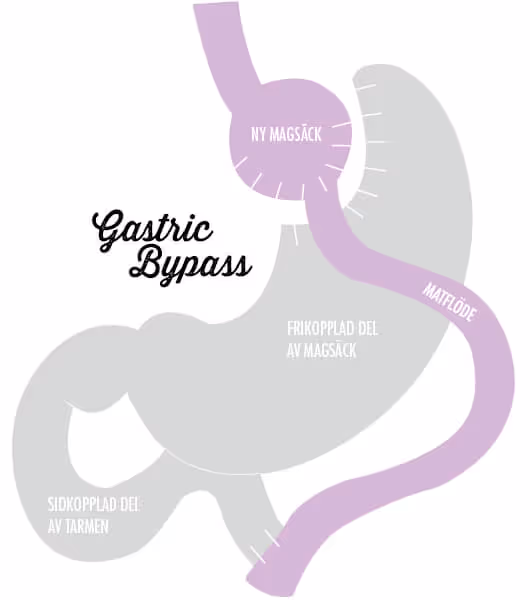 Gastric Bypass - Så fungerar det