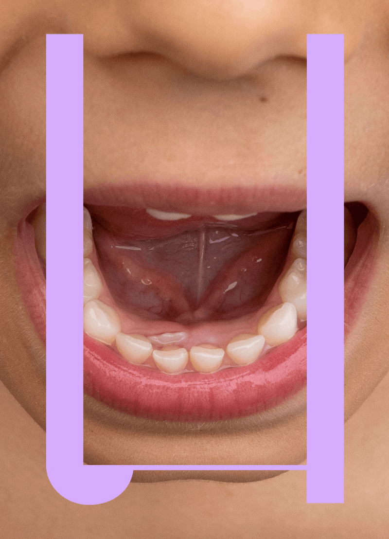 Ooit al eens een gaatje in je tanden gehad? Dan moeten ze dat bij de tandarts vullen met zo'n witte pasta. Dat werkt, maar toch niet altijd optimaal. Want dat vulsel blijft niet altijd even goed zitten en er kunnen ook barstjes en ontstekingen in komen. Daarom ontwikkelt professor Annelies Bronckaers, neurobiologe aan de UHasselt, een nieuw vulsel op basis van je eigen stamcellen. Zij praat erover aan onze podcasttafel met Katleen Bracke.