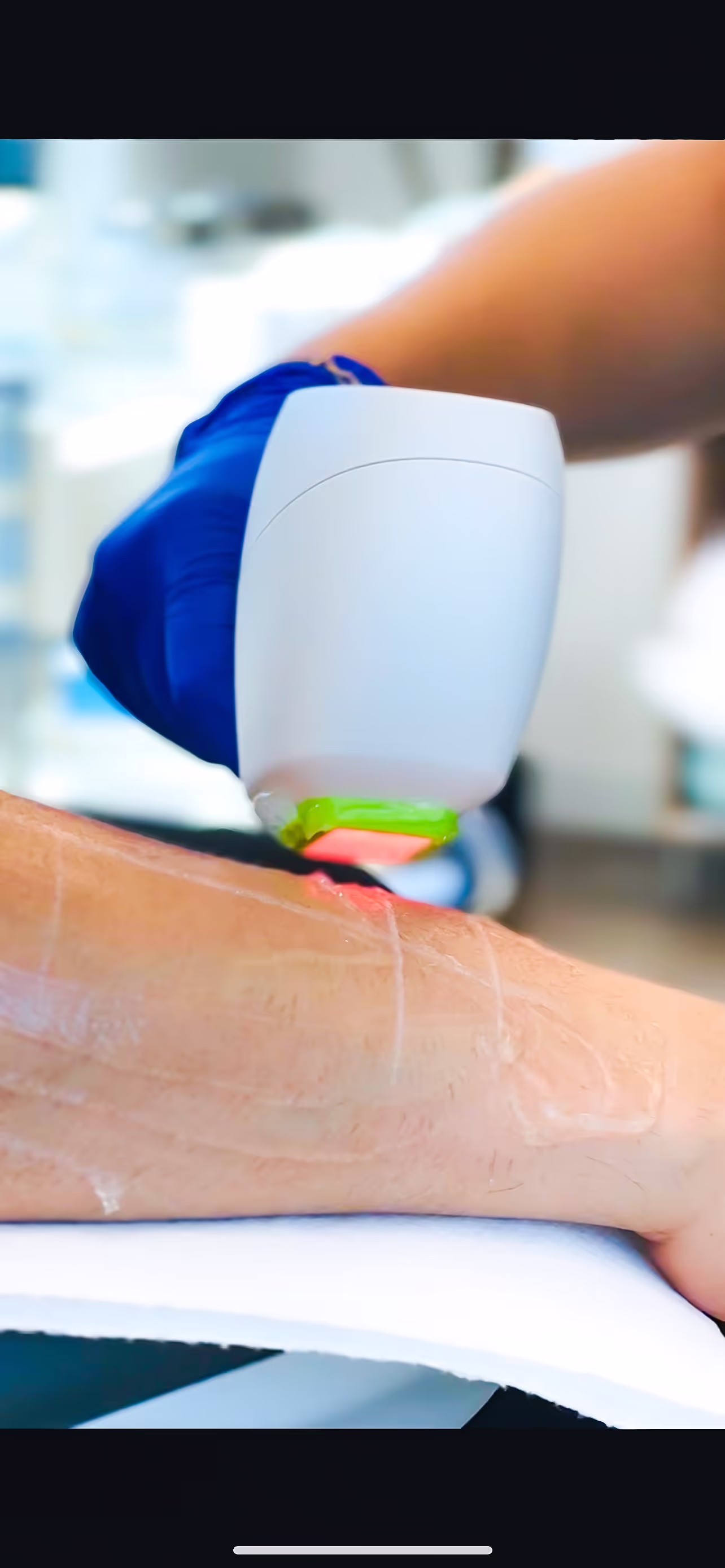 Close-up of a laser device targeting hair follicles on the skin during hair removal treatment.