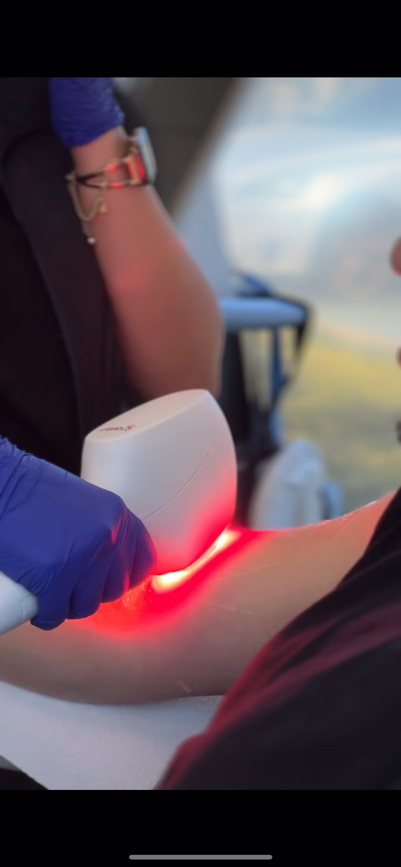 Laser hair removal process being performed on the skin with precision.