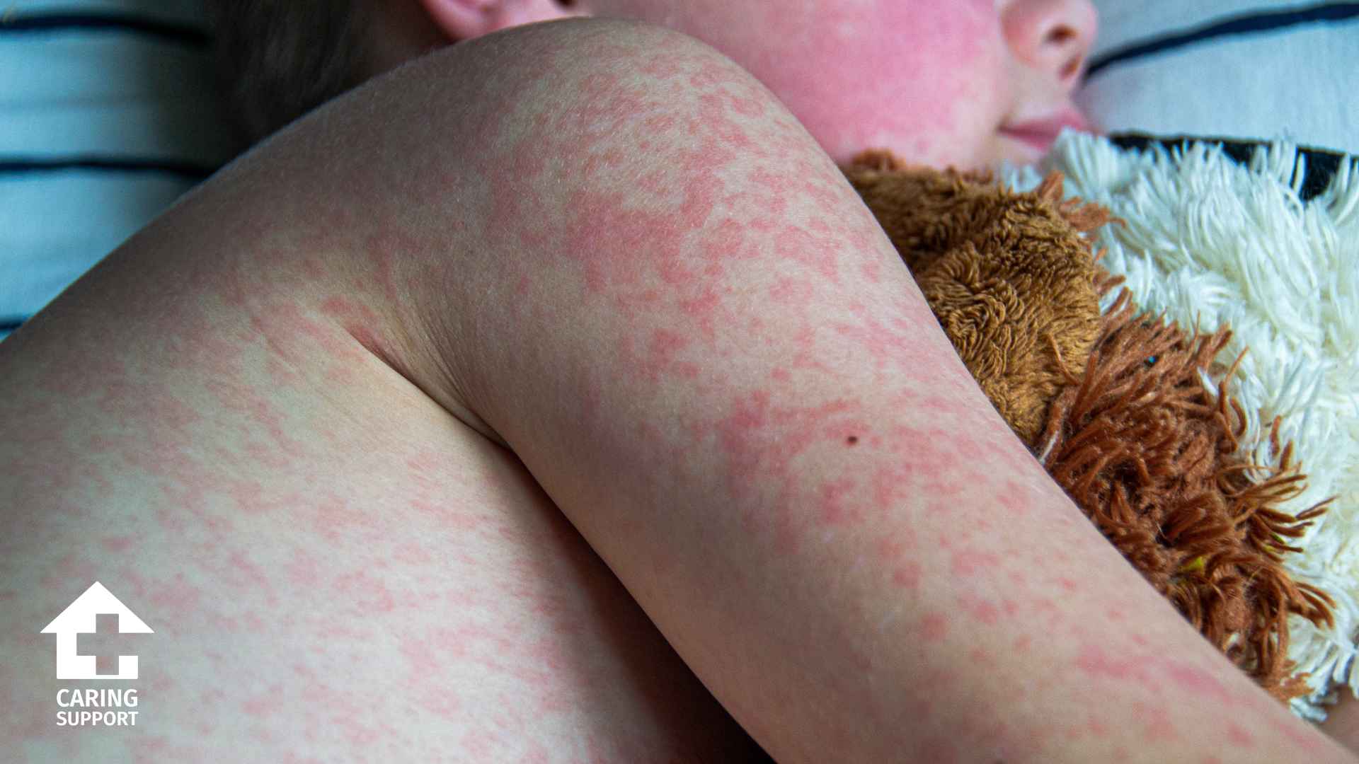 Measles