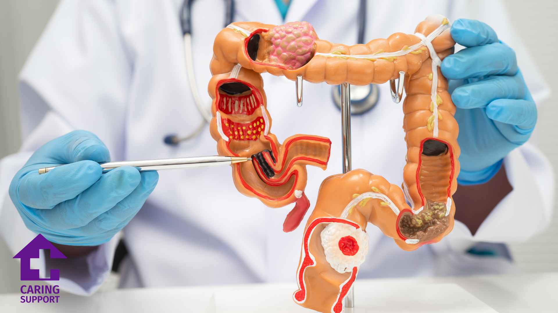 Colorectal Cancer