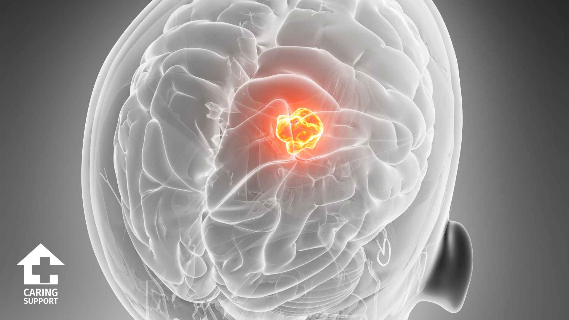 Brain Cancer