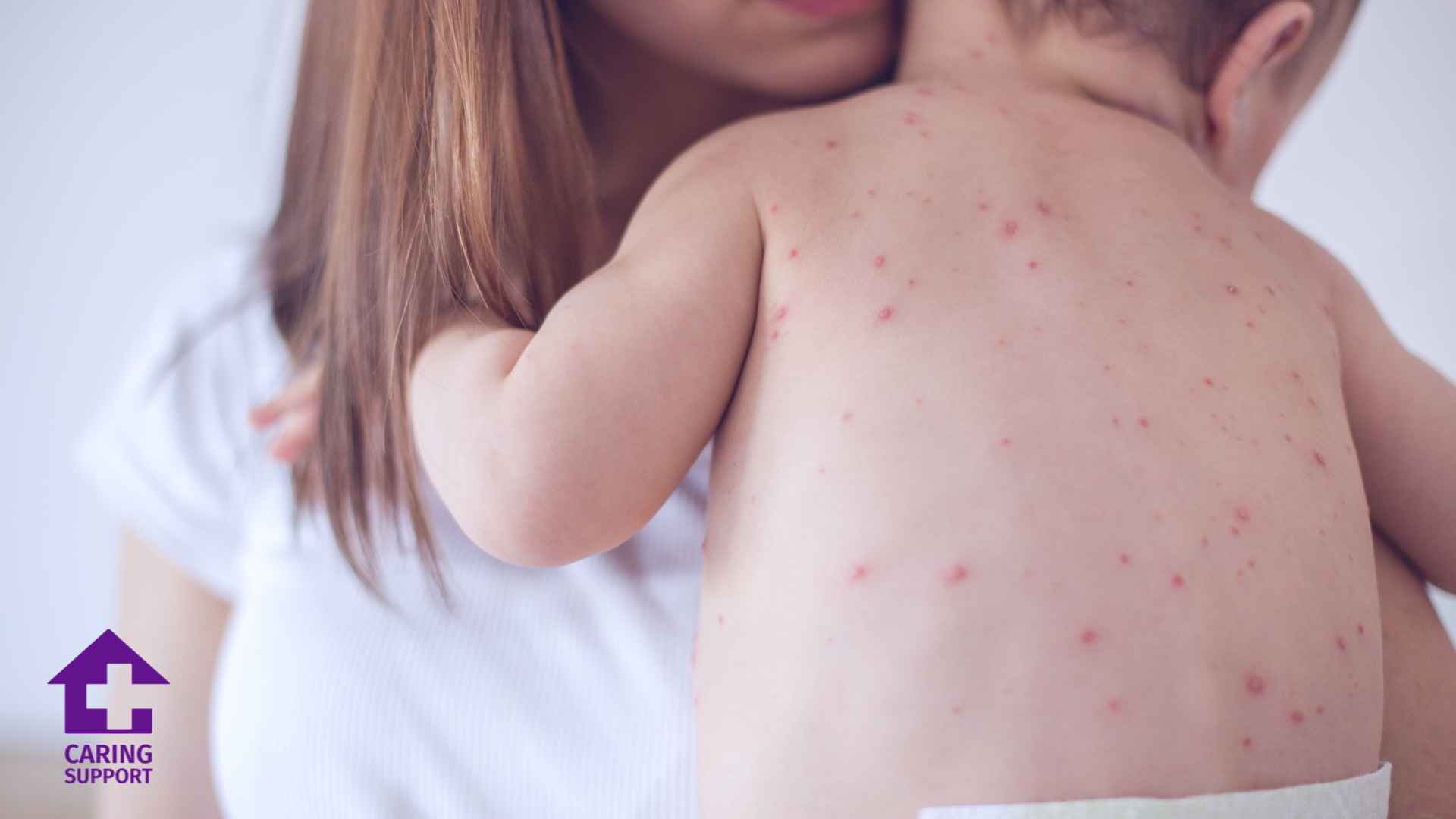 Measles