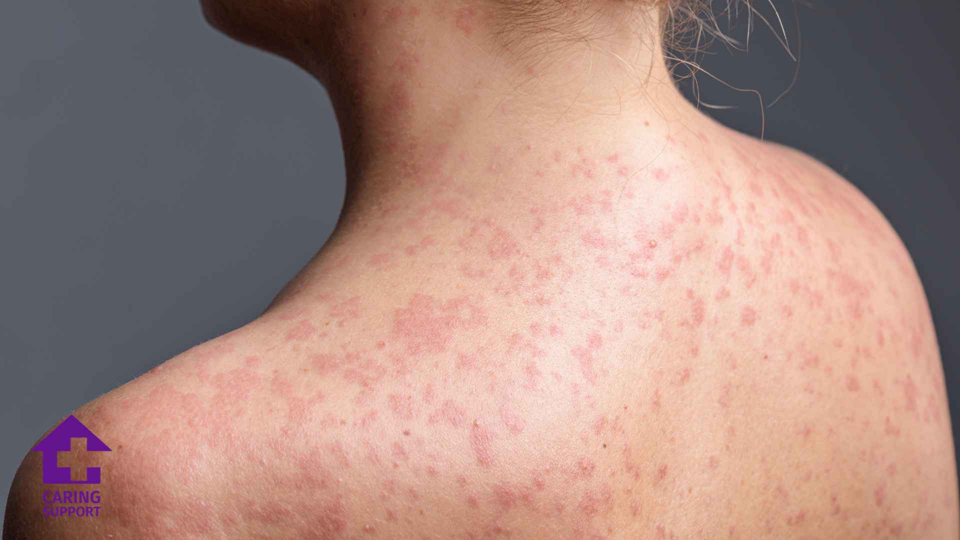 Measles