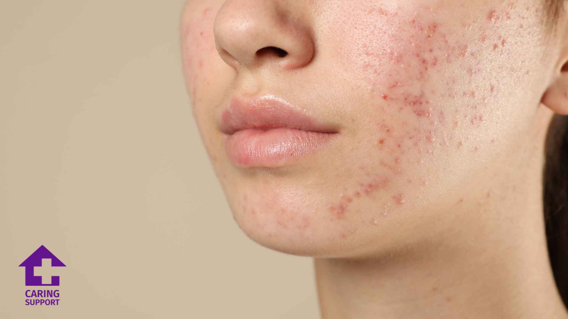 Acne