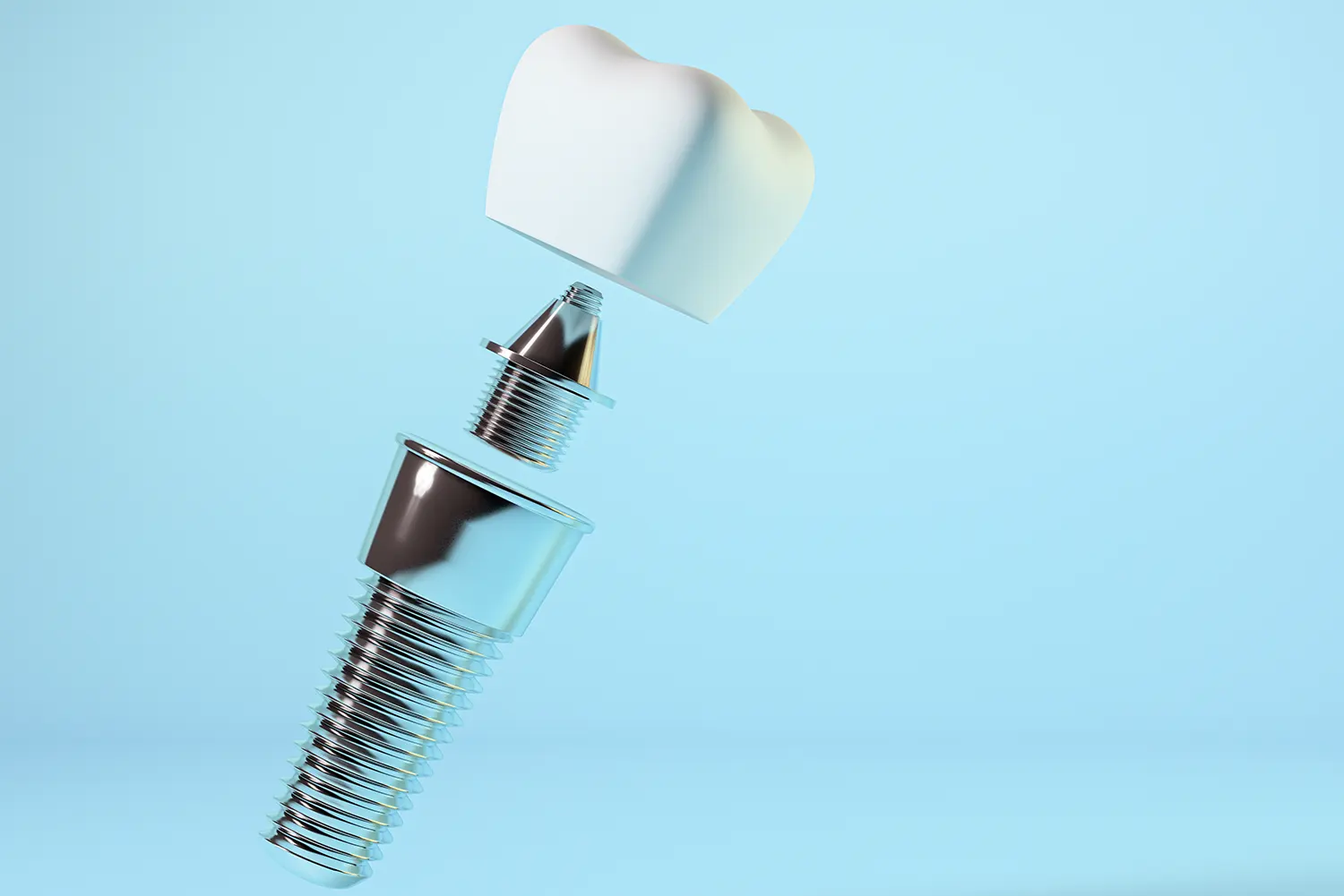 5 Things to Know Before Getting Dental Implants