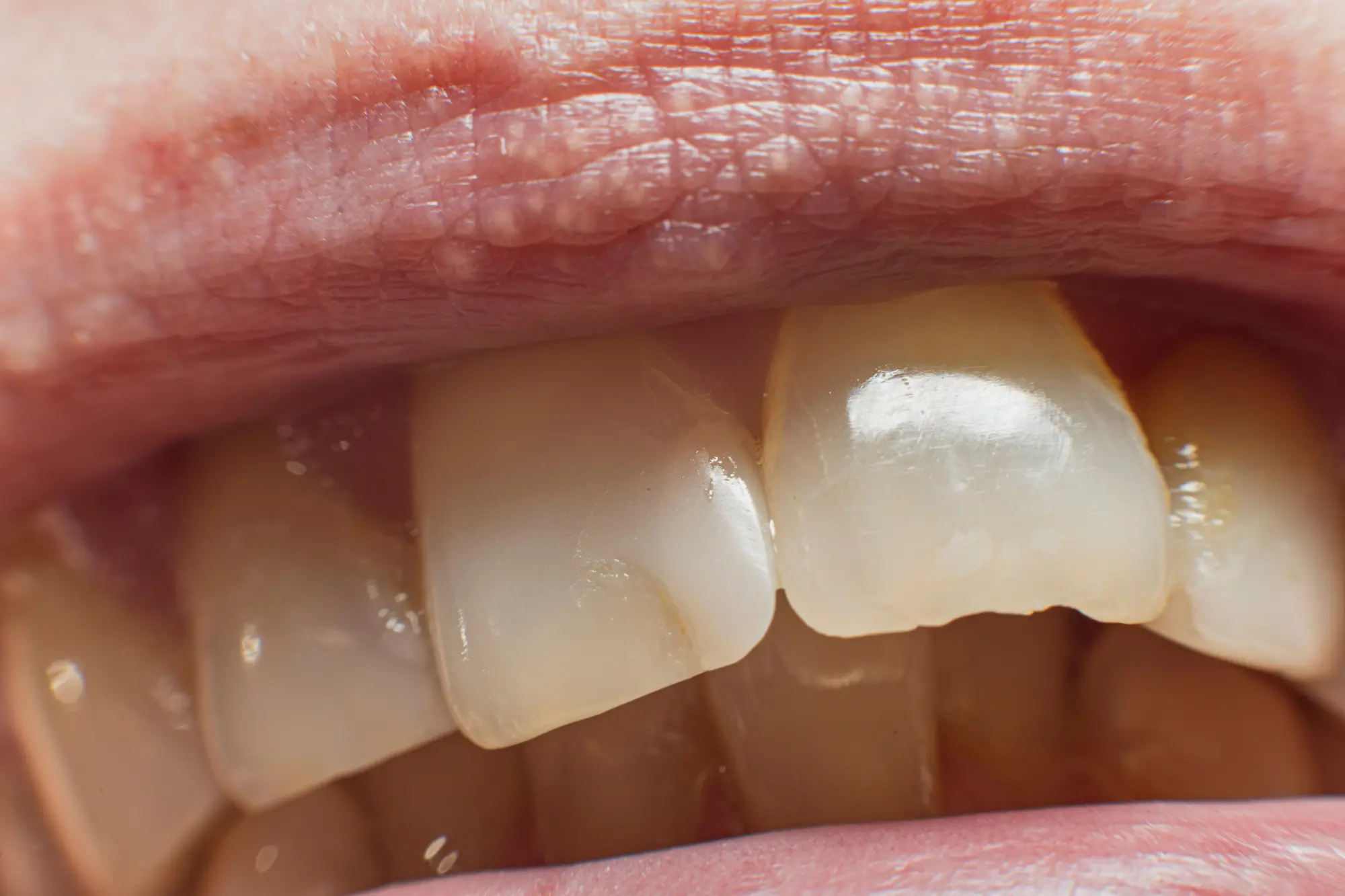 Does a Chipped Tooth Require Emergency Dental Care?
