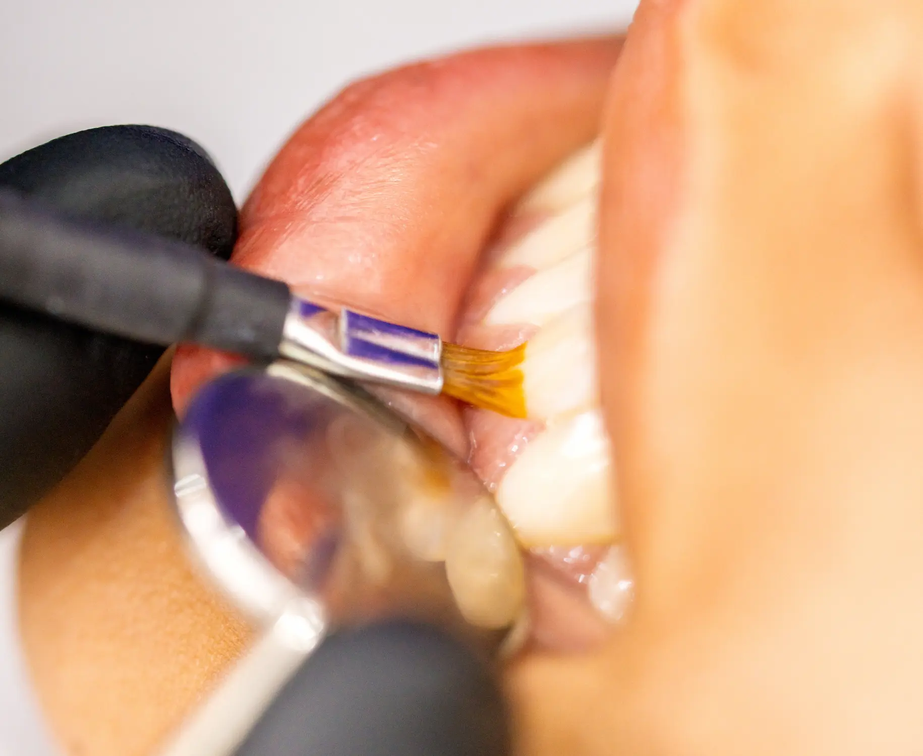dental bonding in Arvada