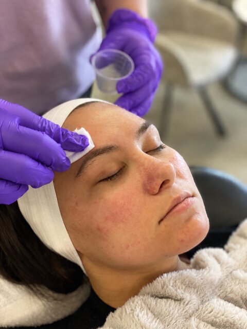 Chemical Peel treatment