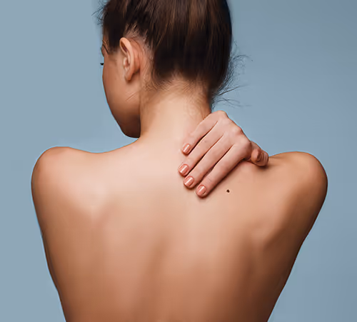 Woman with mole on her back.