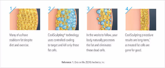 CoolSculpting diagram. Da Vinci Clinic, Tauranga, New Zealand.
