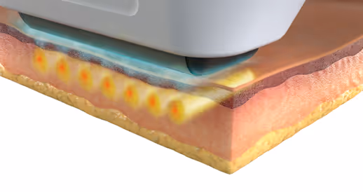 Sofwave treatment diagram.