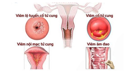 Vùng kín có cặn trắng là dấu hiệu bệnh gì