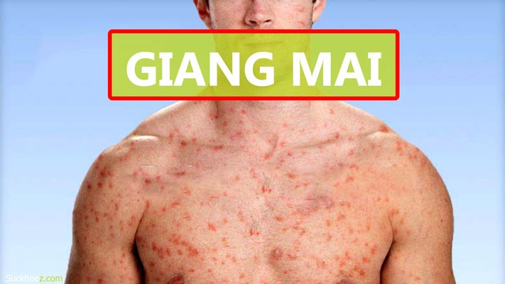 Bệnh giang mai