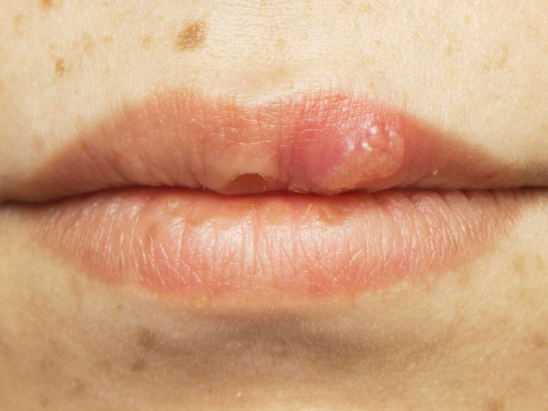 Hình ảnh bệnh sùi mào gà ở miệng