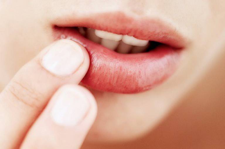 Bệnh sùi mào gà ở miệng: Dấu hiệu nhận biết và cách chữa