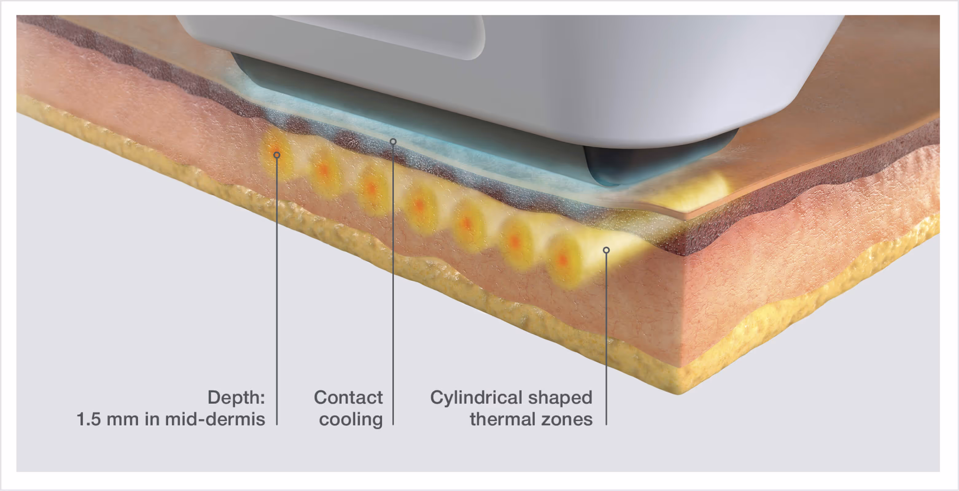 A diagram of the Sofwave treatment.