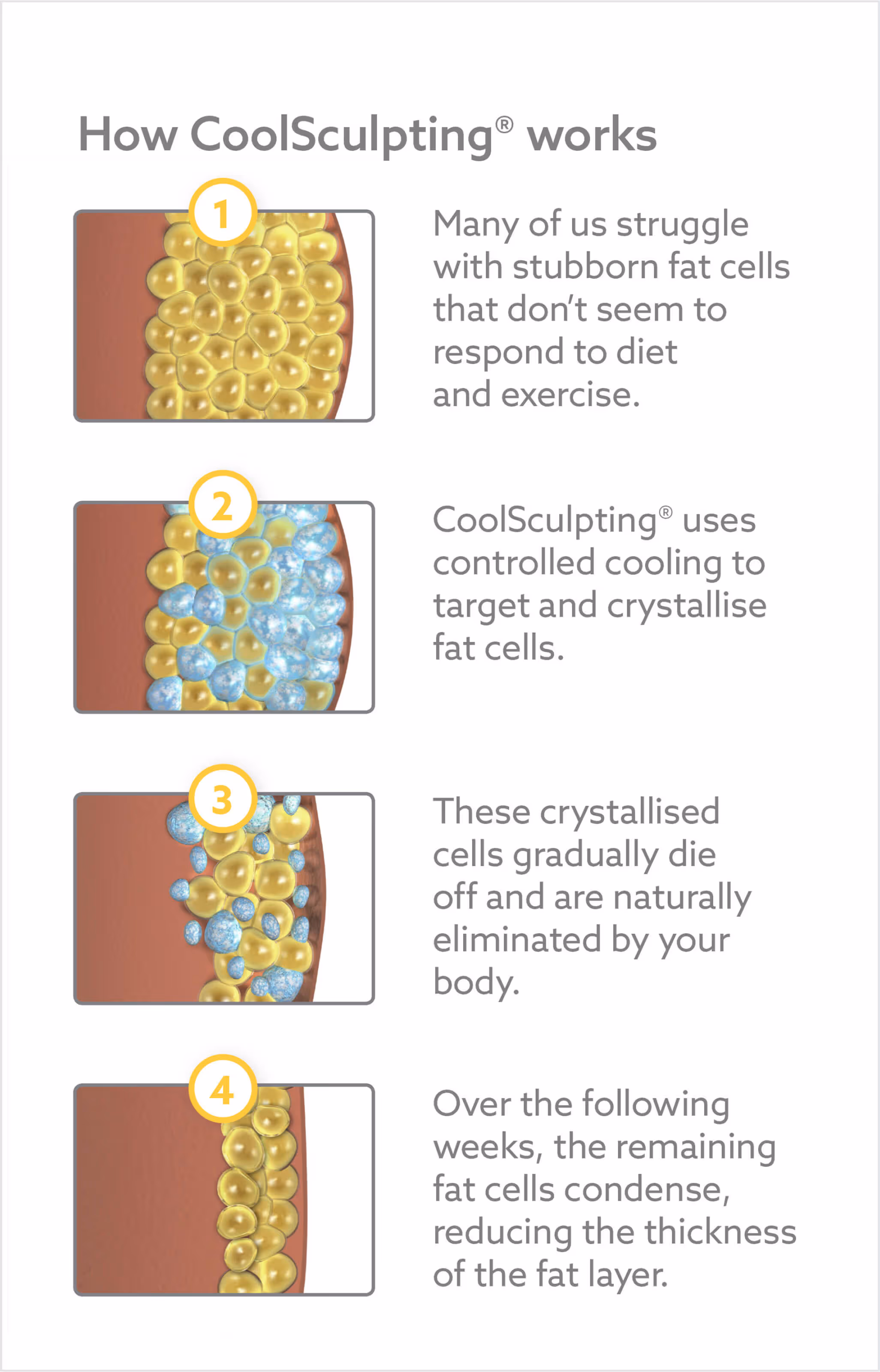 Coolsculpting treatment Diagram. Da Vinic Clinic, Tauranga, New Zealand.