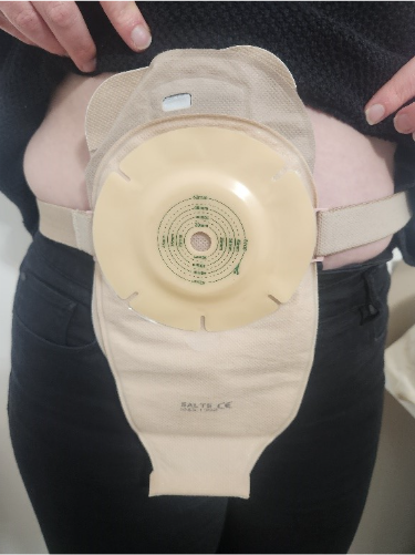 A person wearing a colostomy bagDescription automatically generated