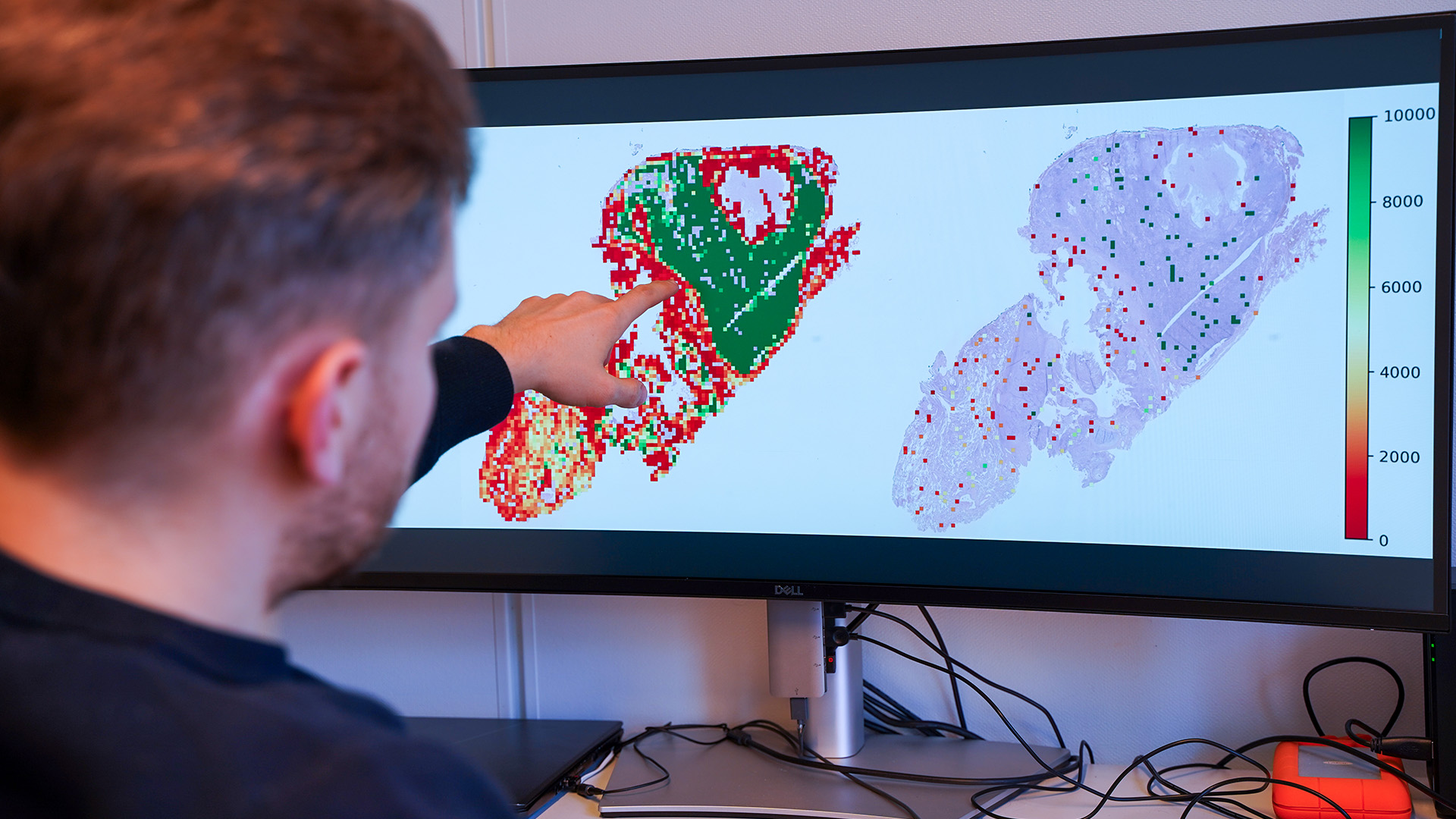 Researcher Nikita Shvetsov has developed an AI system that can contribute to less costly examinations and more personalised cancer treatment.