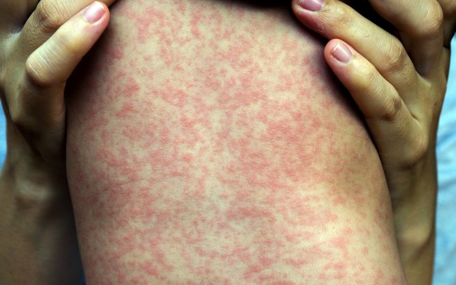 Sarampo é a bola da vez. Se proteja com a vacina