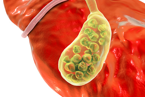 Pedra na vesícula: cálculos que causam dor na região abdominal