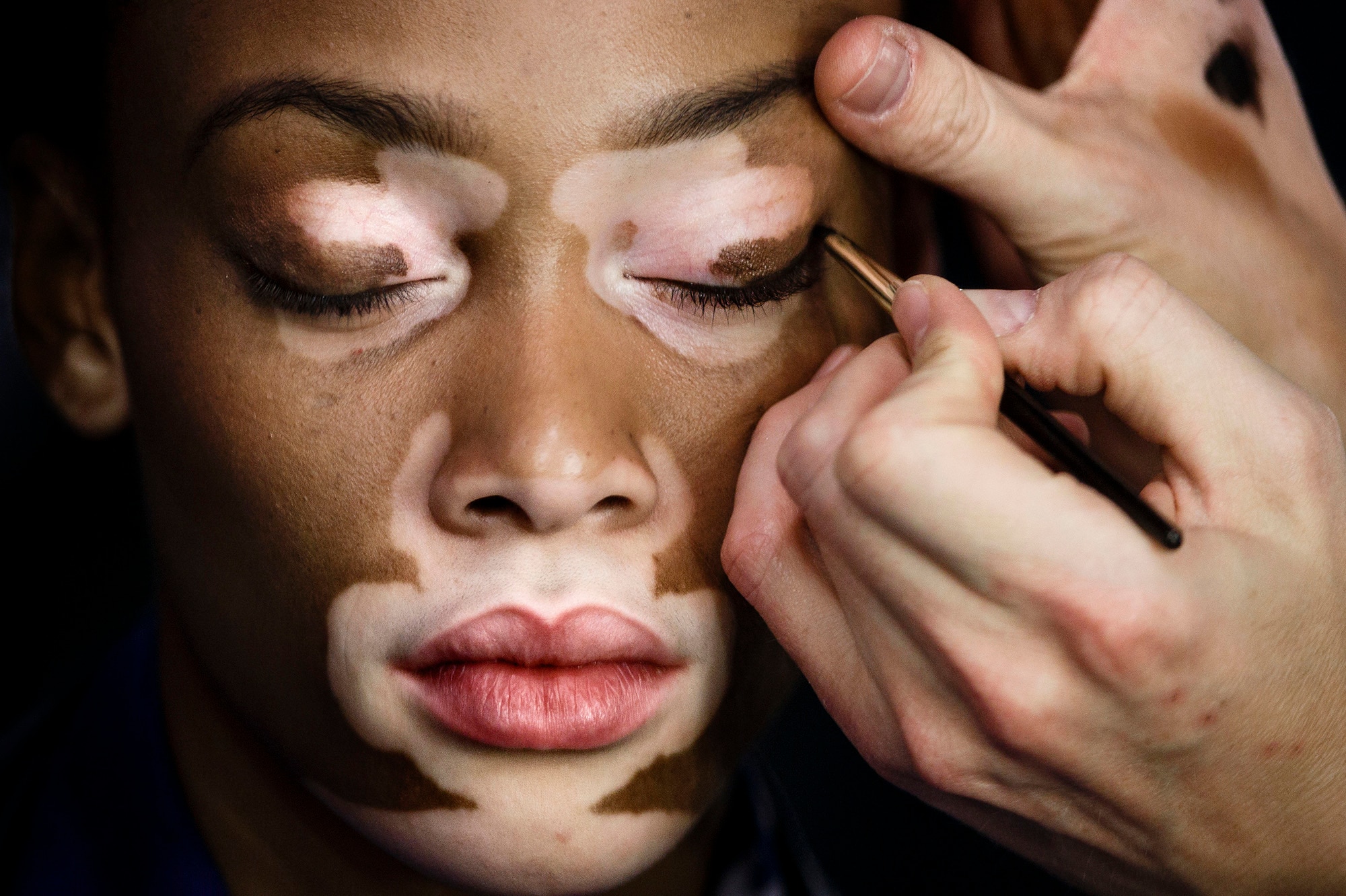 Vitiligo e  preconceito: O que eles tem em comum ?