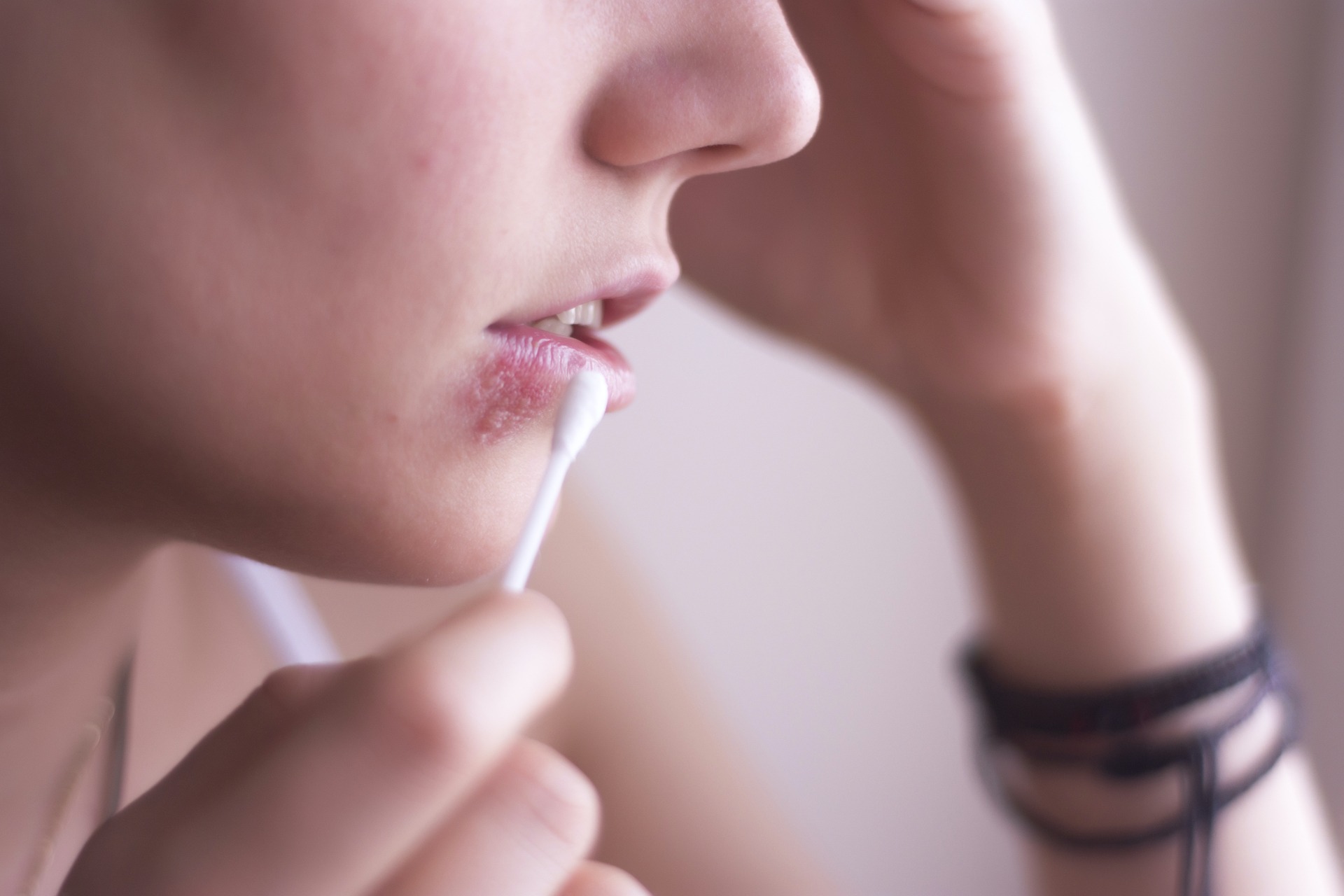 Mais de 70% da população mundial já foi infectada pelo Herpes Simplex Vírus