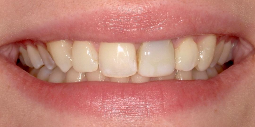 before and after treatment
