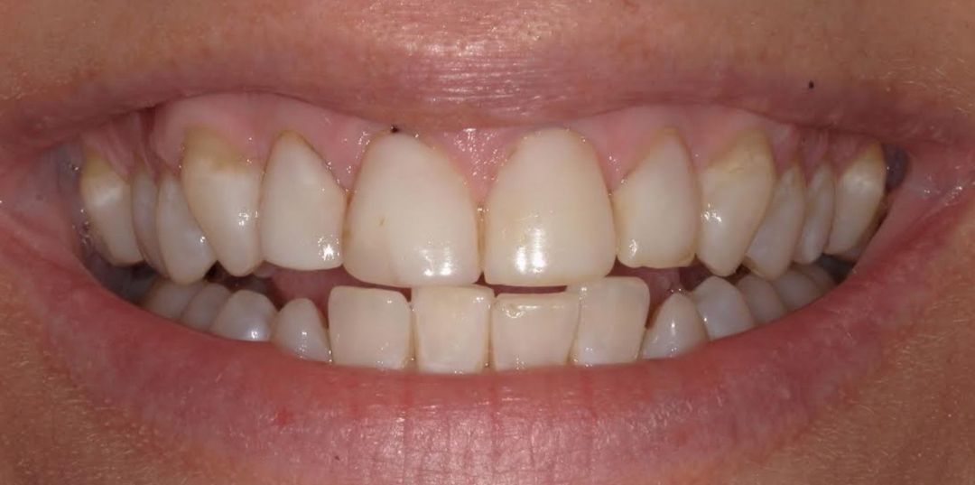 before and after treatment