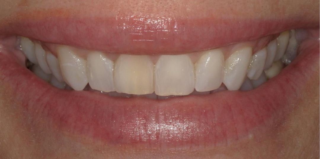 before and after treatment
