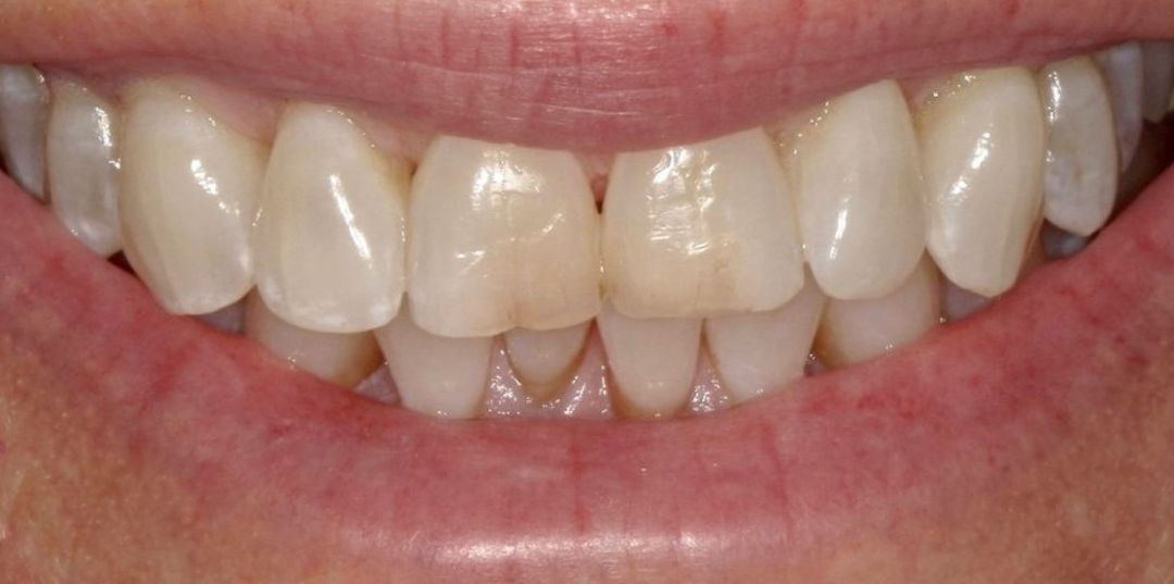 before and after treatment