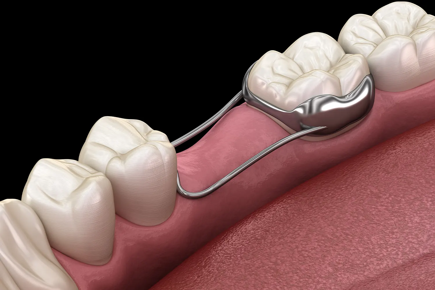 Space Maintainers: Why Protecting the Gap Matters for Your Child's Teeth